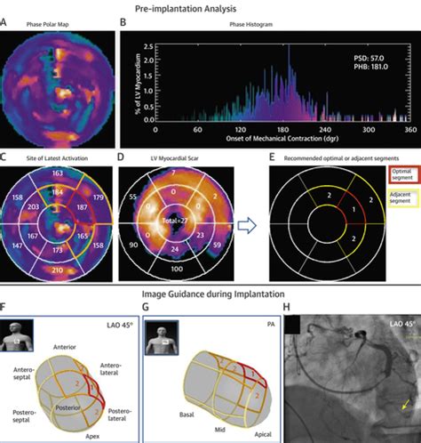 spect guided lv lead placement